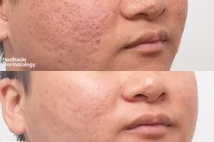 CO2-acne-scar-revision-three