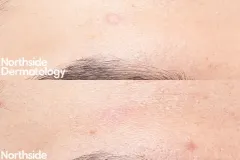 CO2-forehead-before-and-after