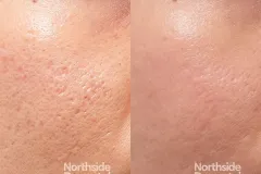 CO2-TCA-cross-before-and-after
