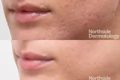 RF-and-TCA-for-acne-scarring