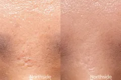 TCA-CO2-acne-scars-before-and-after