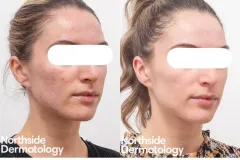 TCA-and-RF-for-acne-scarring