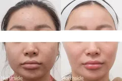 acne-scar-rejuvenation-before-and-after