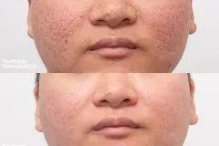 acne-scar-treatment-with-CO2-laser