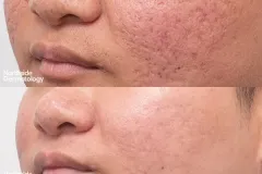 co2-acne-scar-scar-revision