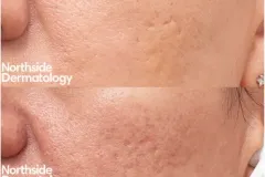 co2-acne-scar