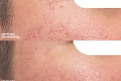 co2-subcision-acne-scars-before-and-after