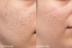 co2-subcision-tca-cheeks