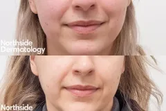 nanofractional-resurfacing-before-and-after