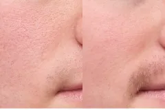 rf-nano-acne-scars-before-and-after