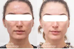 radiofrequency-resurfacing-TCA-results