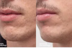 subcision-injection-treatment-for-acne-scar