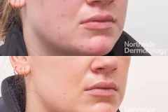 vascular-laser-acne-scar-before-and-after