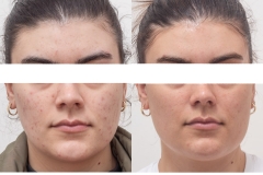 acne-1