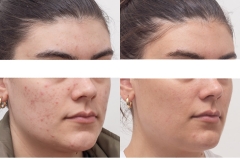 acne-2