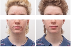 acne-3