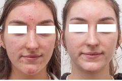 acne-4