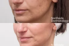 custom-peel-before-after