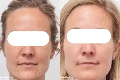 peels-extractions-skincare
