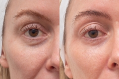 CO2-EYE-rejuvenation-B-and-A-photos