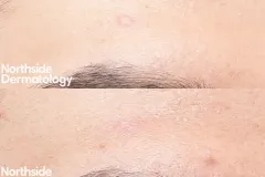 co2-forehead