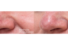 Co2-laser-nose-graft-scar-updated