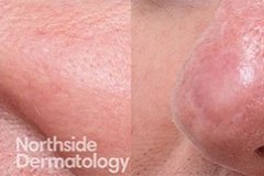 co2-laser-nose-graft-scar