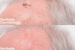 age-spot-treatment-with-co2-laser