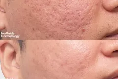 co2-acne-scar-LL-scar-revision-2