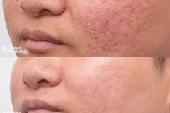 co2-acne-scar-LL-scar-revision