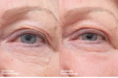 co2-eyelid-laser-blephroplasty-BT