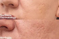 co2-laser-for-acne-scars