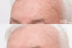 co2-laser-for-sun-damage-and-solar-keratosis