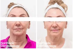 co2-laser-resurfacing-for-sun-damage-and-rejuvenation-2