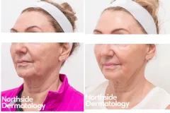 co2-laser-resurfacing-for-sun-damage-and-rejuvenation