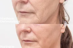 co2-laser-resurfacing-lines-sun-damage-photo-damage