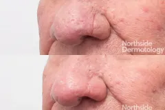 co2-laser-rhinophyma-and-scar