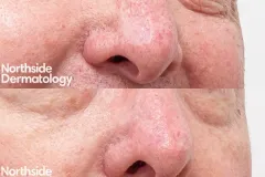 co2-laser-skin-graft-nose