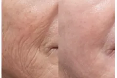 co2-laser-wrinkle-reduction