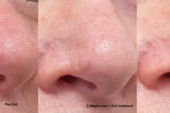 co2-resurfacing-skin-cancer-scar-graft