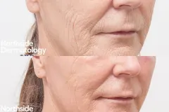 co2-resurfacing-wrinkles