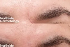 co2-traumatic-scar-resurfacing