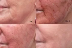 recovery-photos-following-co2-laser