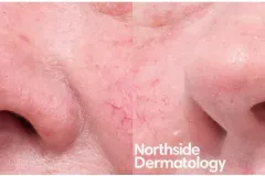 rhinophyma-reduction-with-co2-laser-3