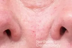 rhinophyma-reduction-with-co2-laser