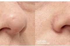 subcision-co2-laser-scar