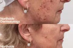 1927nm-laser-actinic-keratosis-treatment