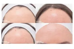 recovery-photos-following-laser-resurfacing