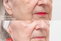 laser-resurfacing-rhytides-improvement