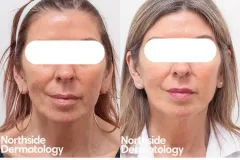 laser-resurfacing-skin-rejuvenation-wrinkle-reduction